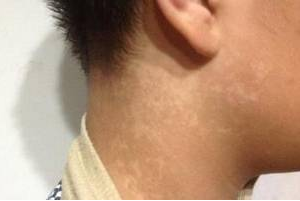 局限型白癜风怎么治