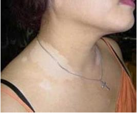 局限型白癜风发病原因是什么